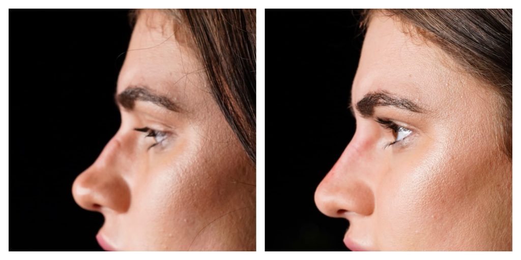 Botox for slimming wide nose